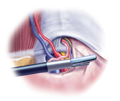 Laparoscopic Inguinal Hernia Repair